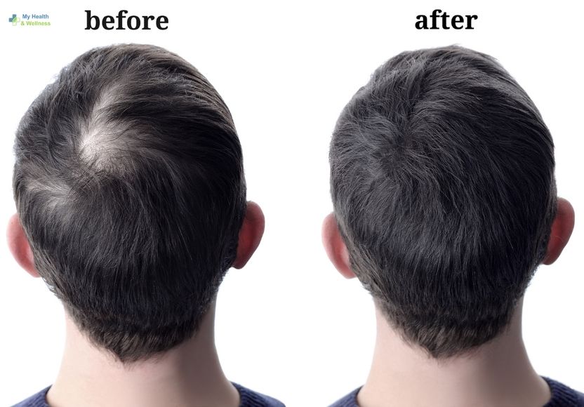 hair loss treatments